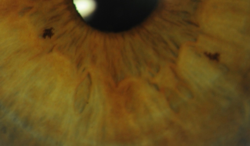 Irisdiagnose